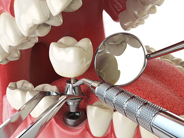 Best Chipped Tooth Repair Near Me  in Alto, TX